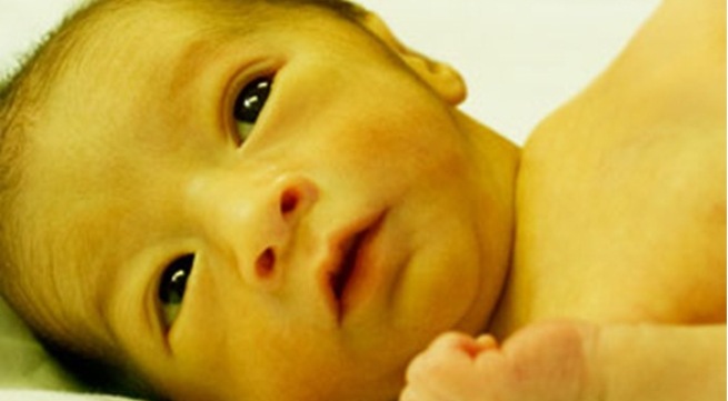 bệnh vàng da ở trẻ sơ sinh hình 1
